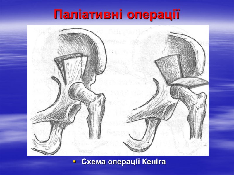 Паліативні операції Схема операції Кеніга